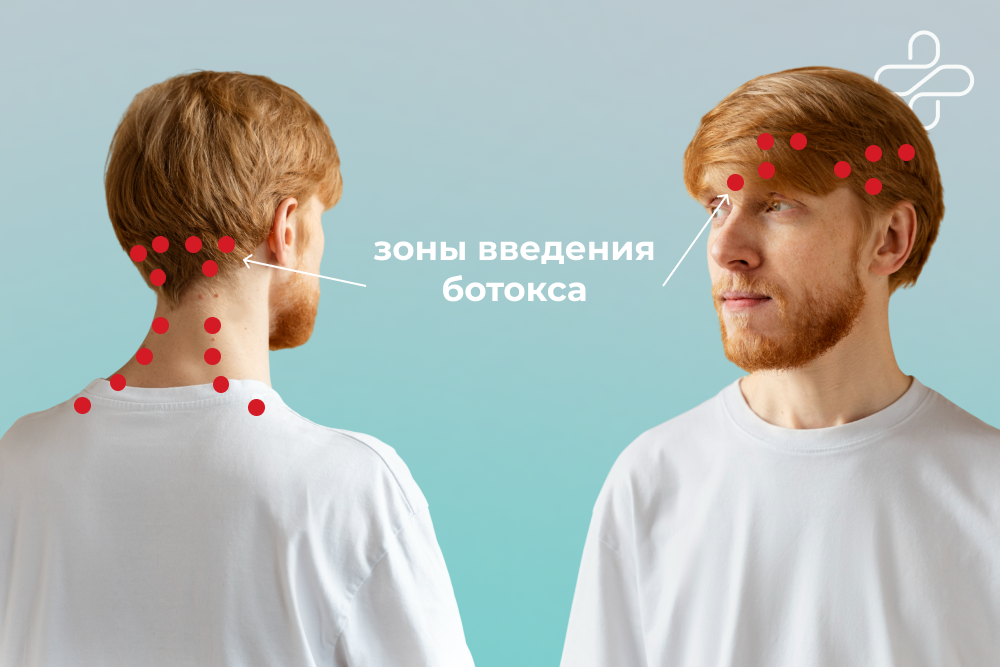 зоны введения ботокса
